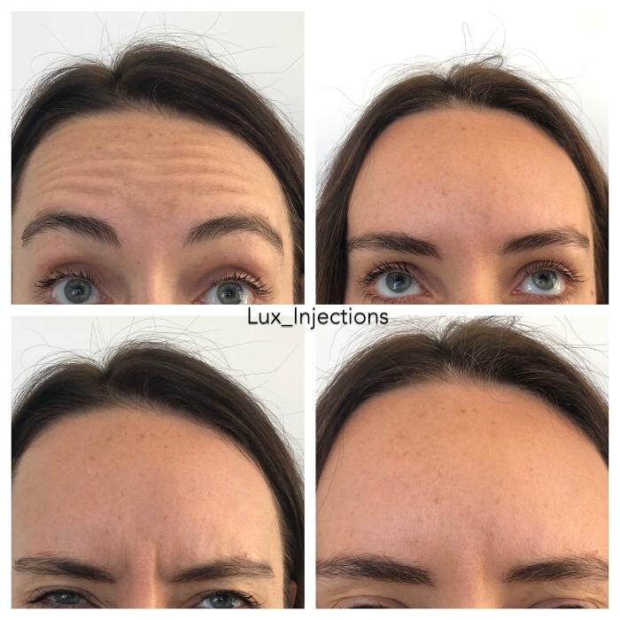 Images Lux Injections