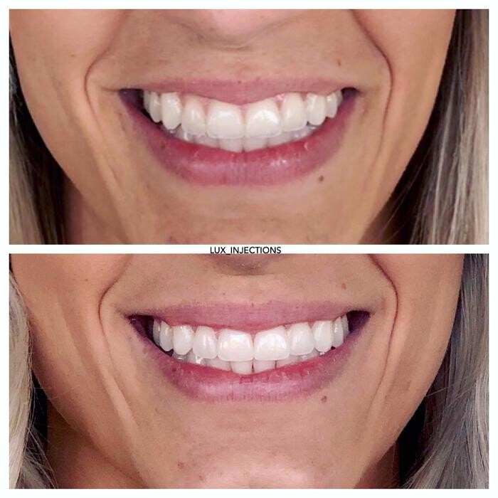 Images Lux Injections