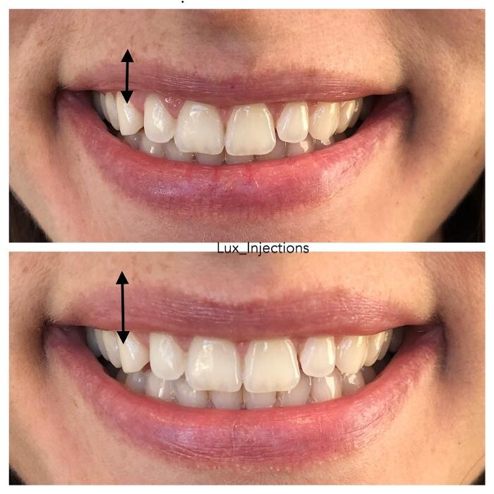 Images Lux Injections