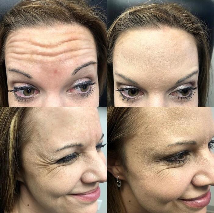Images Lux Injections