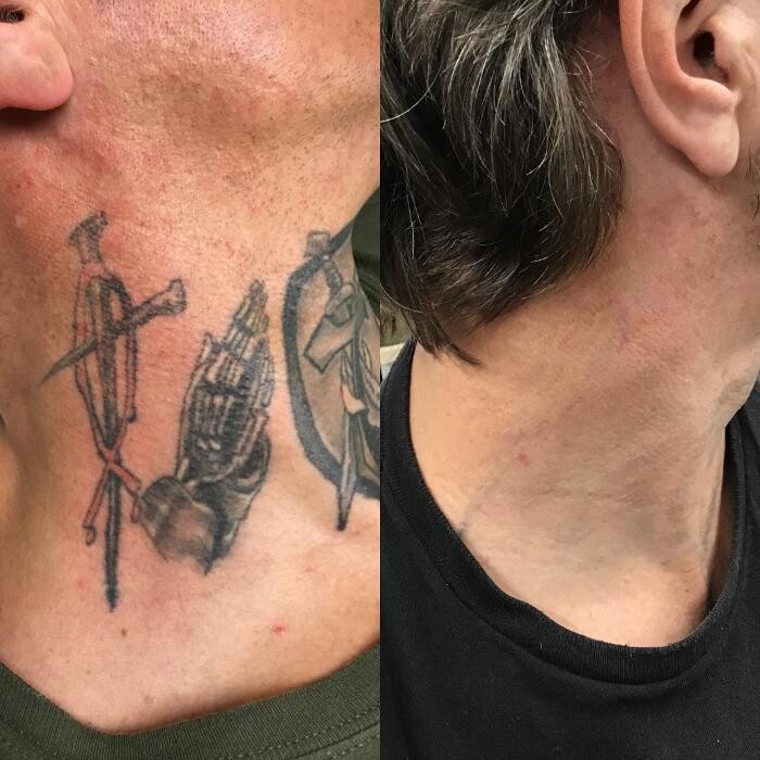 Images Removery Tattoo Removal & Fading