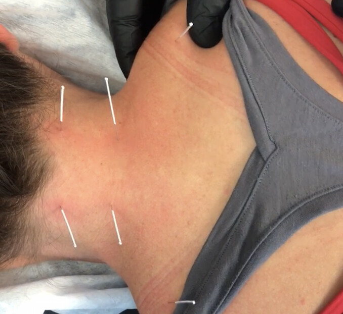 Images Westminster Sports Chiropractic