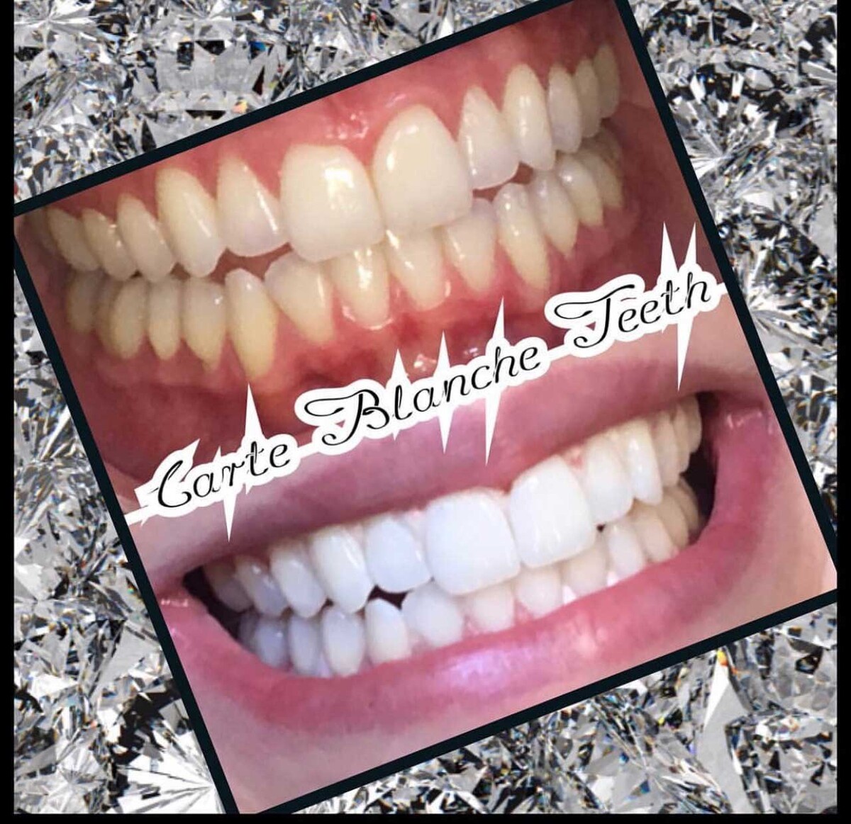 Images Carte Blanche Teeth Whitening