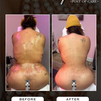 Images Lymphatic Post-Op Spa