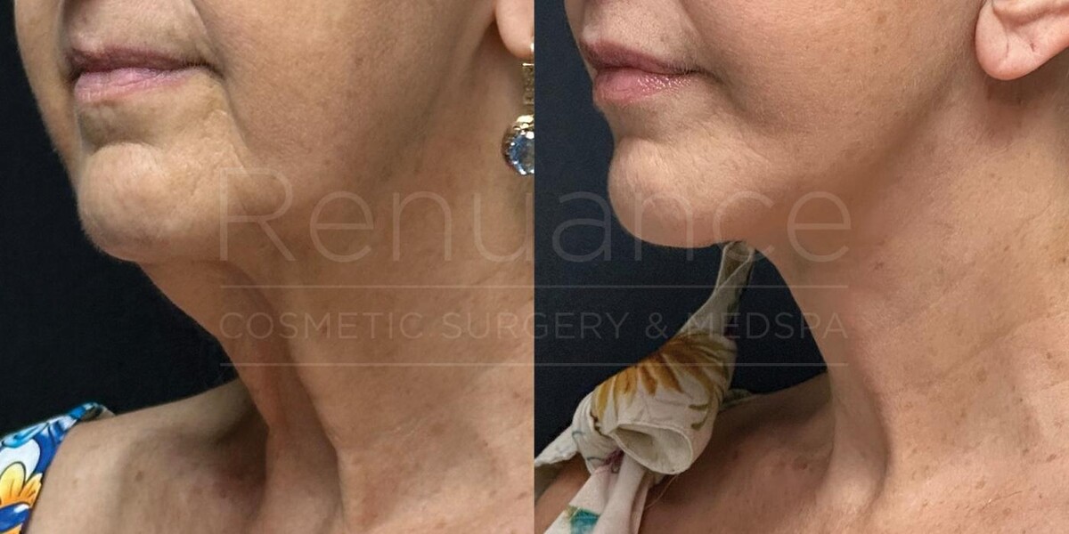 Images Renuance Cosmetic Surgery & MedSpa - Rancho Bernardo