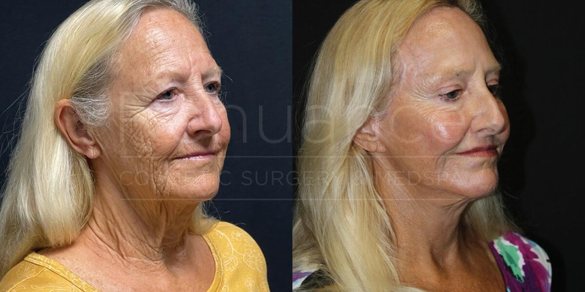 Images Renuance Cosmetic Surgery & MedSpa - Rancho Bernardo