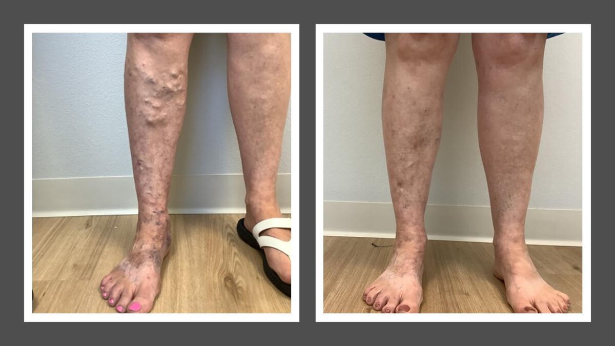 Images Fort Worth Vein Center | Dr. Barry Oswalt, now part of CVR