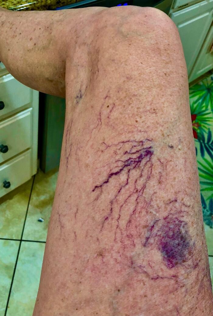 Images Fort Worth Vein Center | Dr. Barry Oswalt, now part of CVR