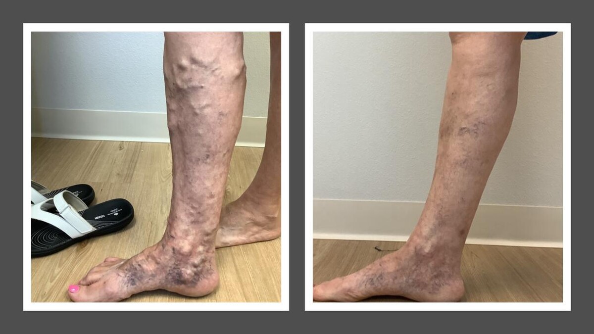 Images Fort Worth Vein Center | Dr. Barry Oswalt, now part of CVR