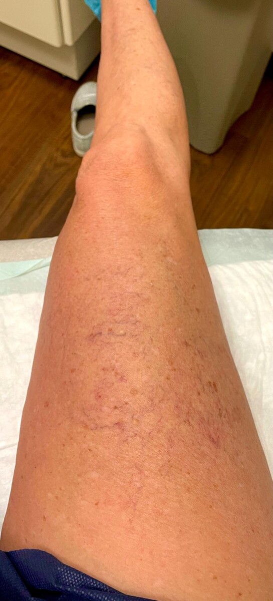 Images Fort Worth Vein Center | Dr. Barry Oswalt, now part of CVR