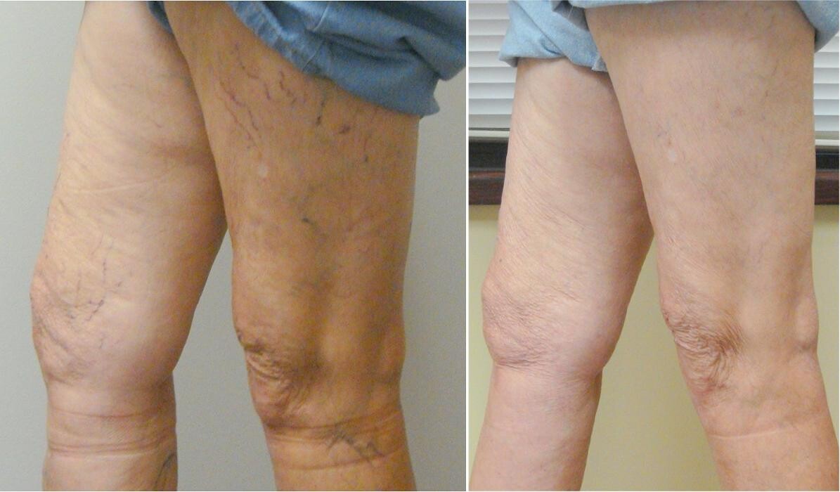 Images Vein Specialists of the Carolinas: Dr. David G. Draughn, now part of CVR