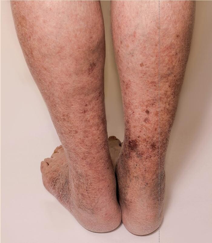 Images Vein Specialists of the Carolinas: Dr. David G. Draughn, now part of CVR