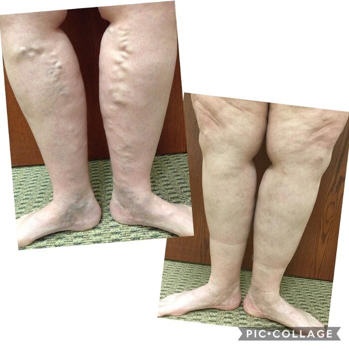 Images Vein Specialists of the Carolinas: Dr. David G. Draughn, now part of CVR