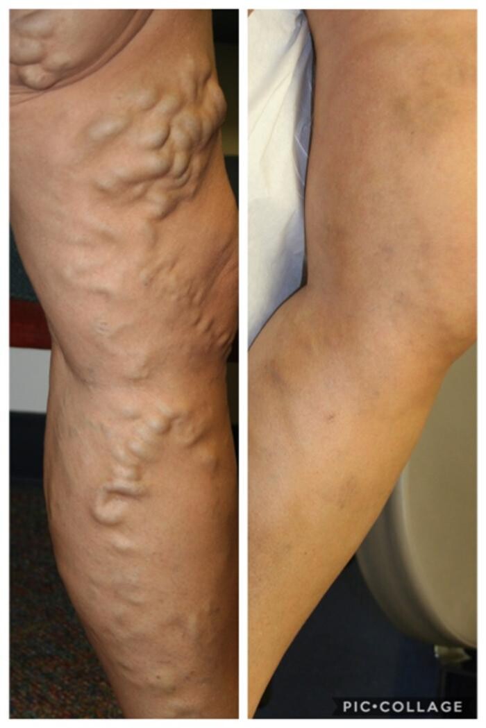 Images Vein Specialists of the Carolinas: Dr. David G. Draughn, now part of CVR