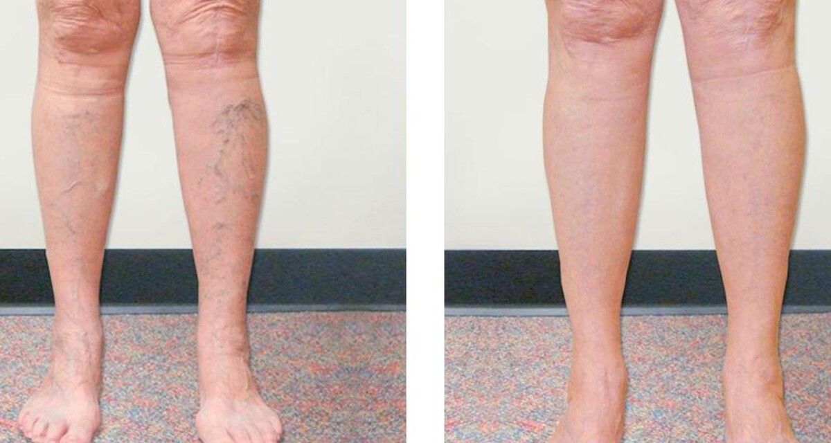 Images Vein Specialists of the Carolinas: Dr. David G. Draughn, now part of CVR