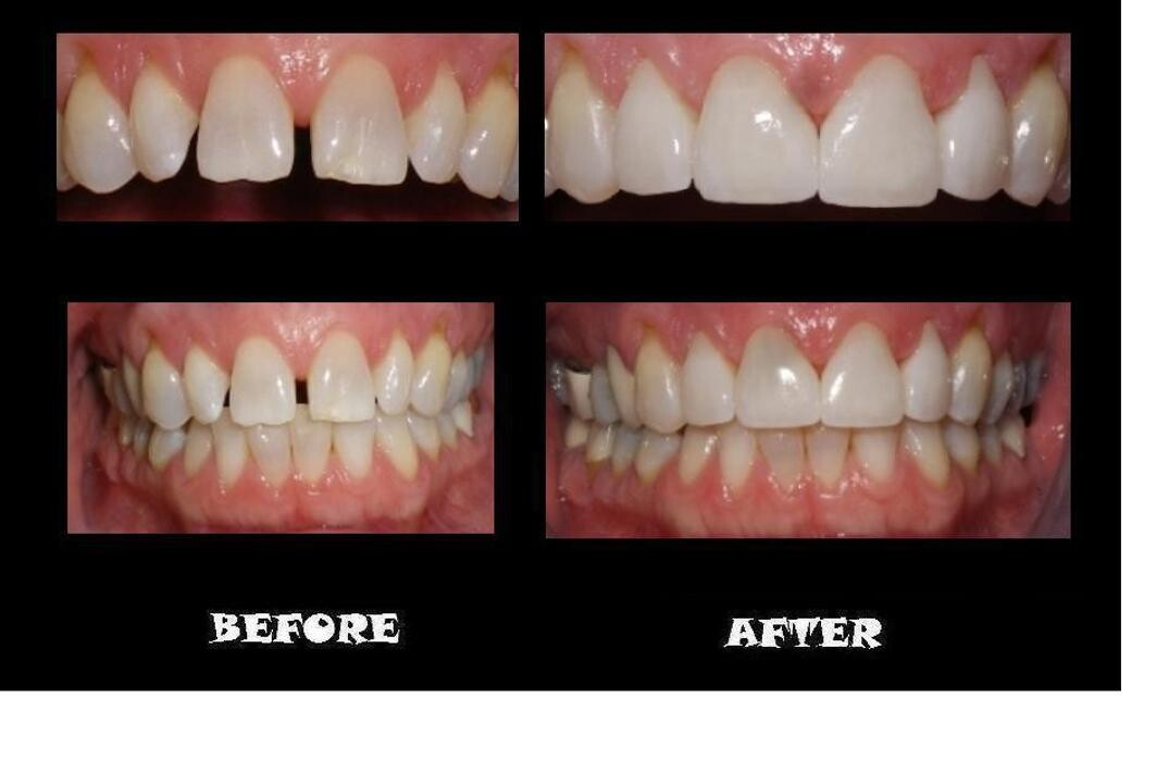 Images Designer Smiles