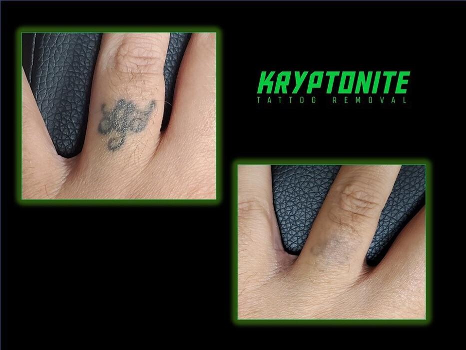 Images Kryptonite Laser Professionals