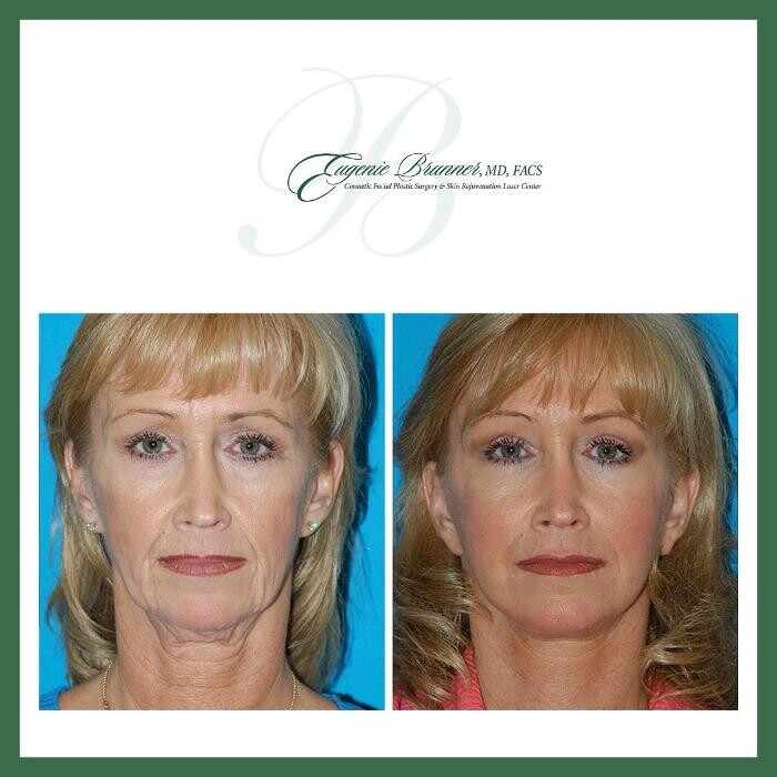 Images Eugenie Brunner, MD, FACS