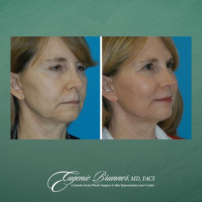 Images Eugenie Brunner, MD, FACS