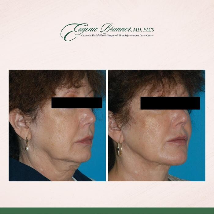 Images Eugenie Brunner, MD, FACS