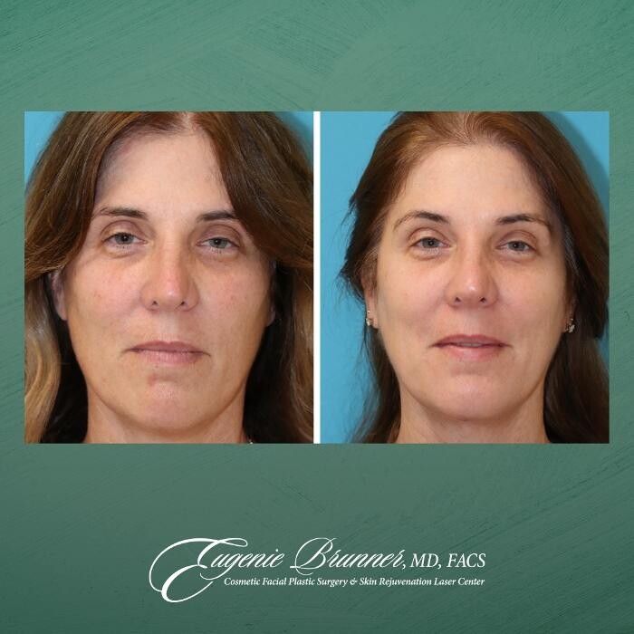 Images Eugenie Brunner, MD, FACS