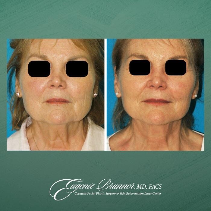 Images Eugenie Brunner, MD, FACS