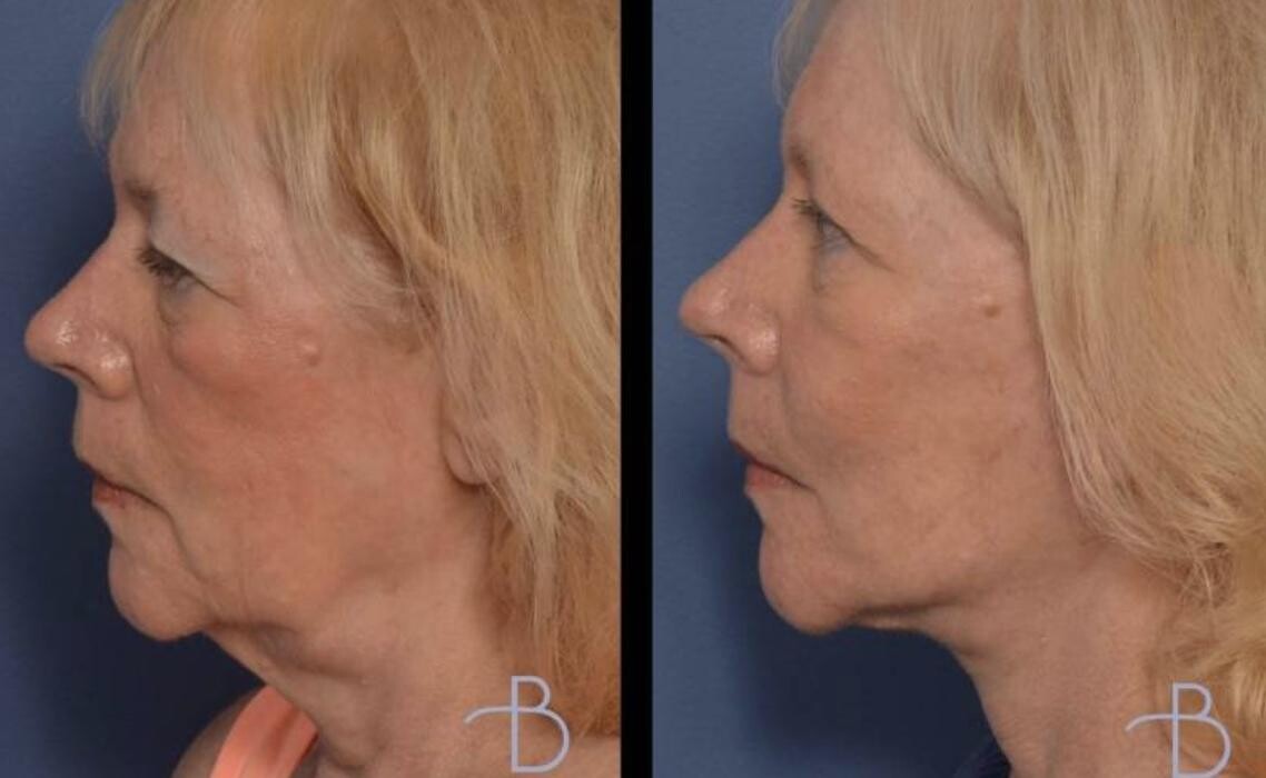 Images Agata Brys, MD Facial Plastic Surgery