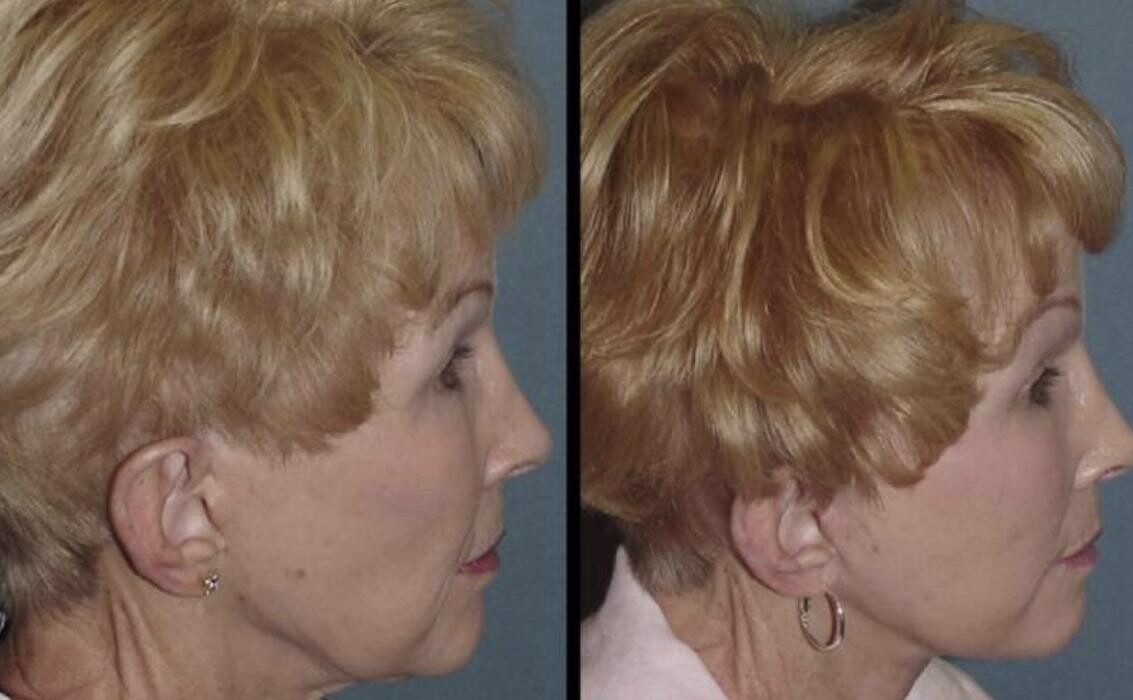 Images Agata Brys, MD Facial Plastic Surgery