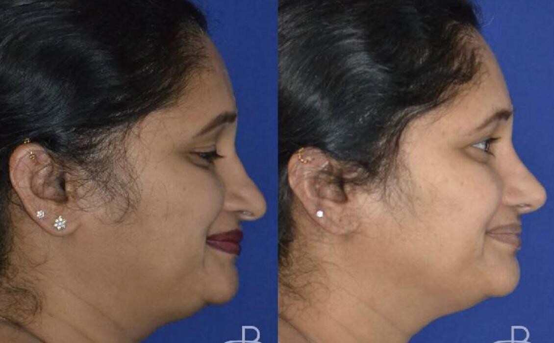 Images Agata Brys, MD Facial Plastic Surgery