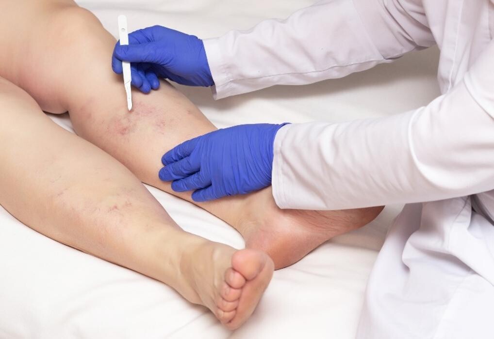Images California Vein & Vascular Centers