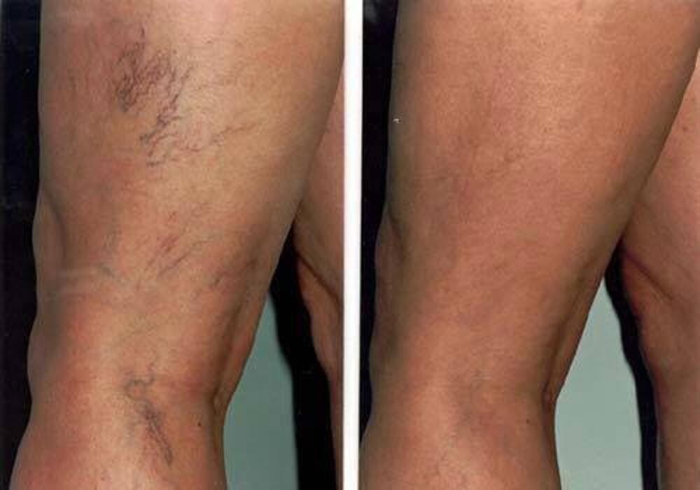 Images Vein Clinics of Hawaii: Randall Juleff, MD, FACS