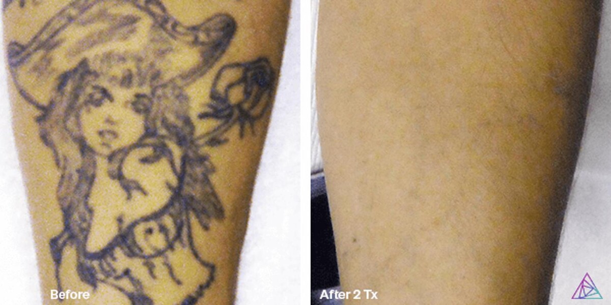 Images Sierra Tattoo Removal