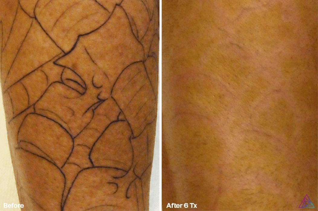 Images Sierra Tattoo Removal