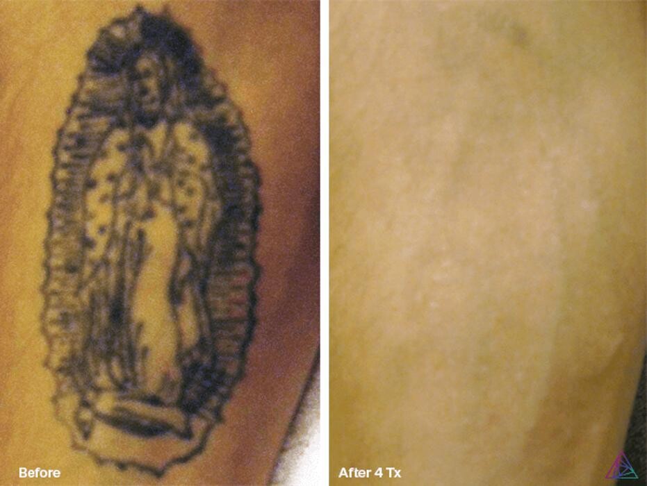 Images Sierra Tattoo Removal