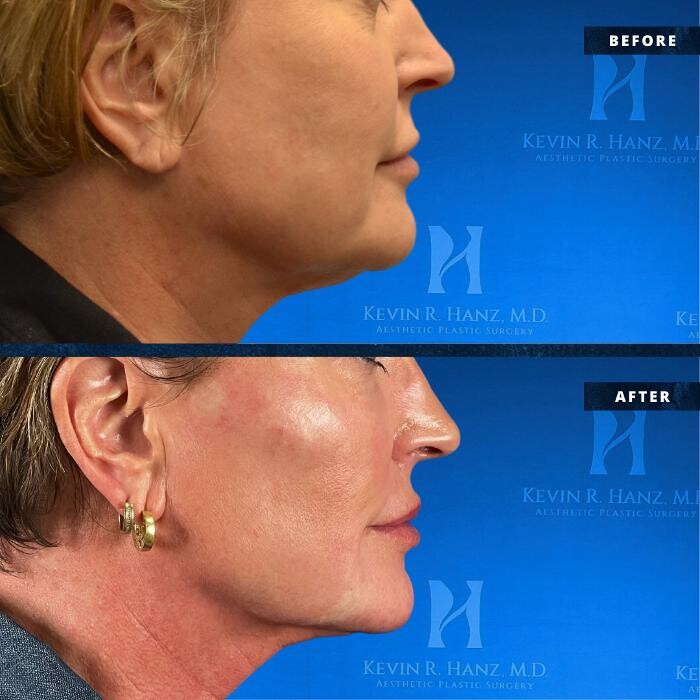 Images Kevin R. Hanz, MD. Aesthetic Plastic Surgery