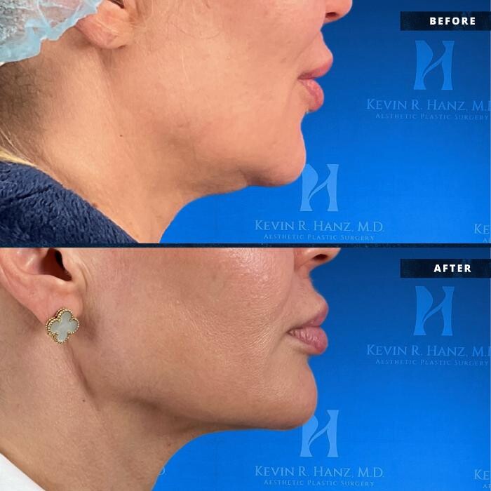 Images Kevin R. Hanz, MD. Aesthetic Plastic Surgery