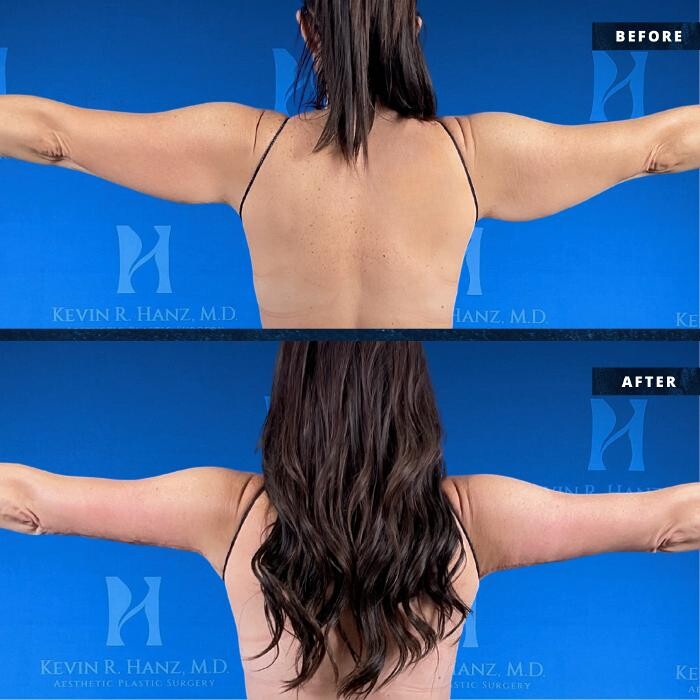 Images Kevin R. Hanz, MD. Aesthetic Plastic Surgery