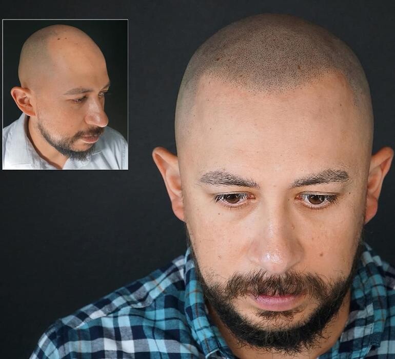 Images Picasso Scalp Micropigmentation - California