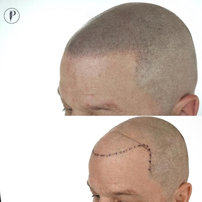 Images Picasso Scalp Micropigmentation - California