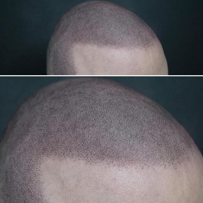 Images Picasso Scalp Micropigmentation - California