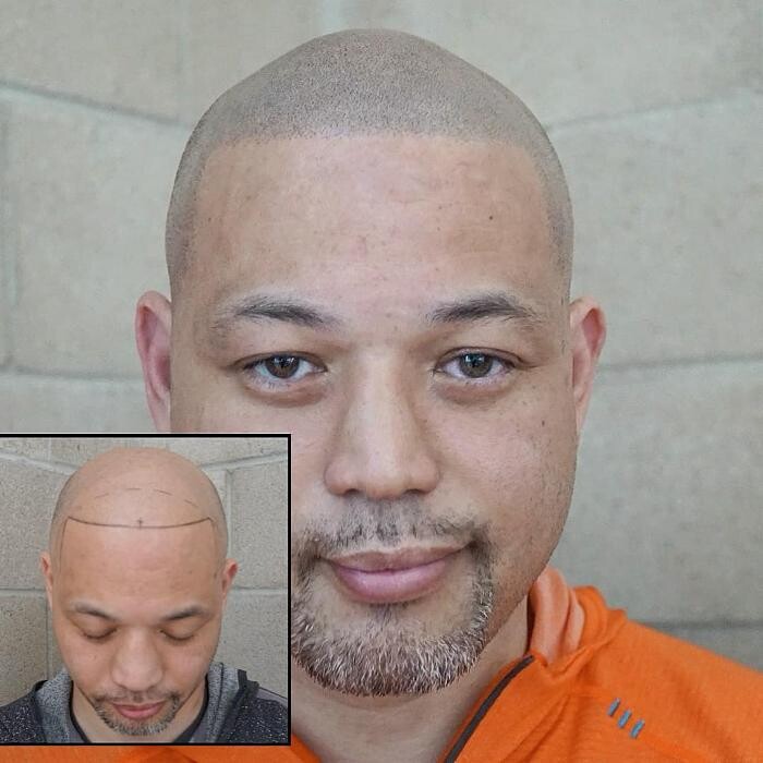 Images Picasso Scalp Micropigmentation - California