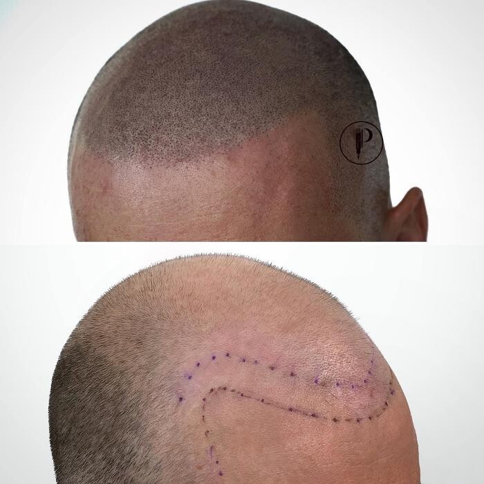 Images Picasso Scalp Micropigmentation - California