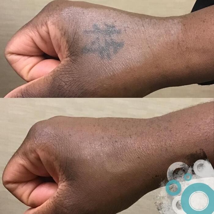 Images Removery Tattoo Removal & Fading