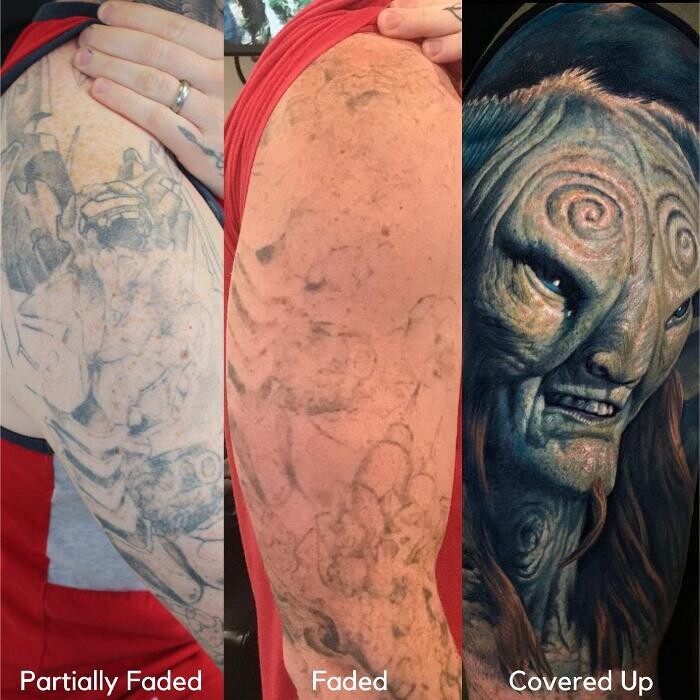 Images Removery Tattoo Removal & Fading