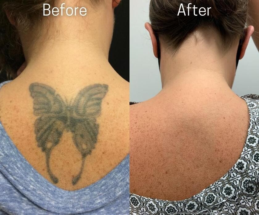 Images Removery Tattoo Removal & Fading