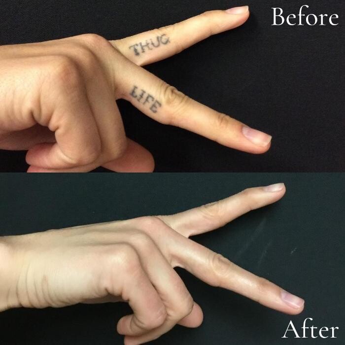 Images Removery Tattoo Removal & Fading
