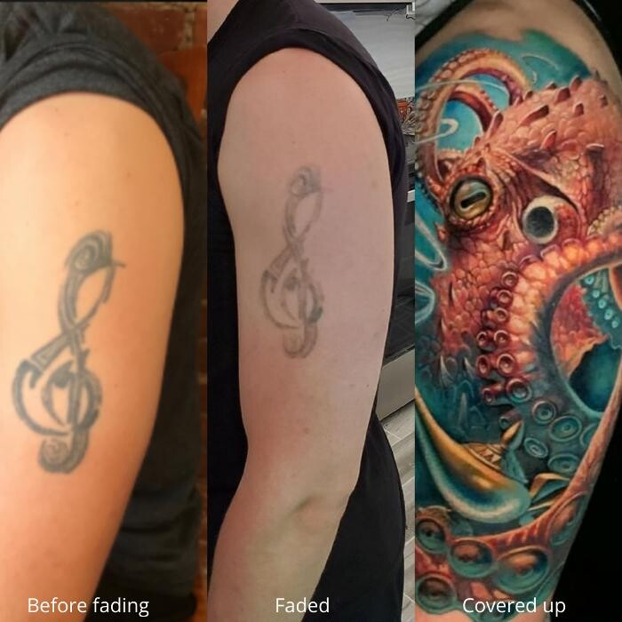 Images Removery Tattoo Removal & Fading