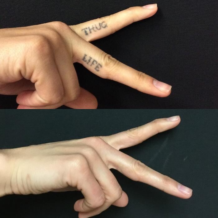 Images Removery Tattoo Removal & Fading