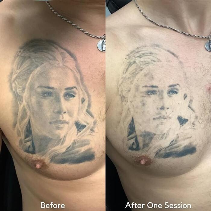 Images Removery Tattoo Removal & Fading