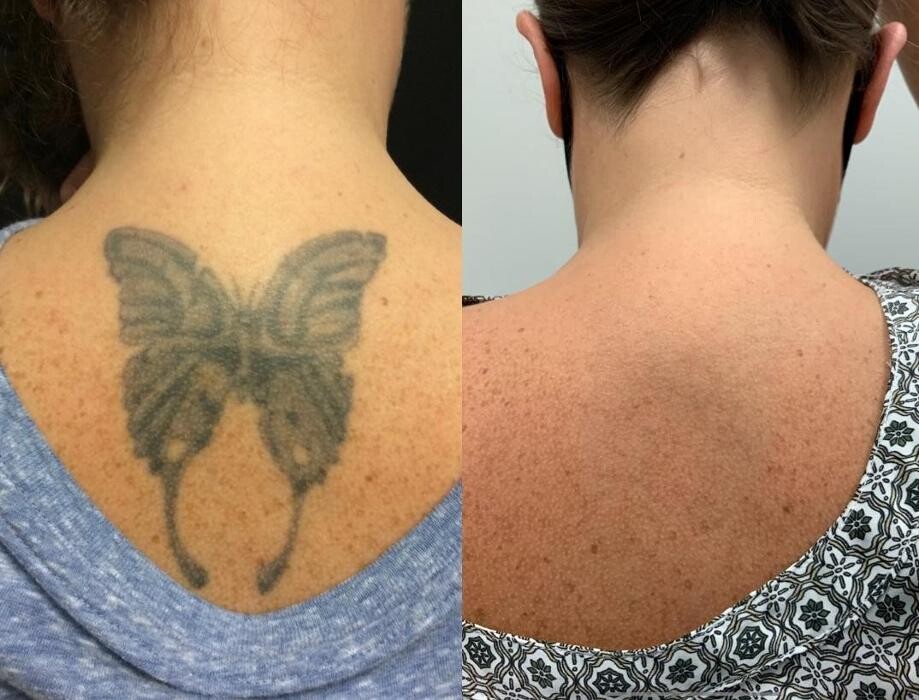 Images Removery Tattoo Removal & Fading